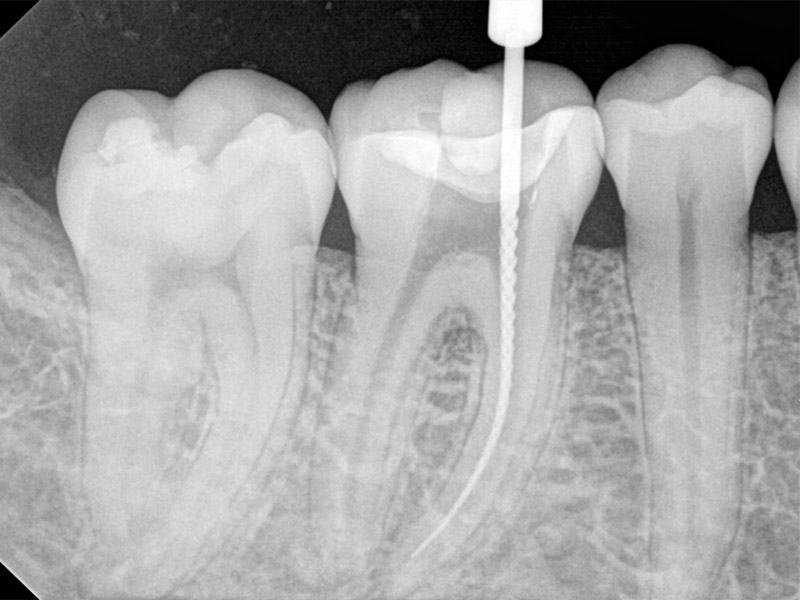Endodoncia